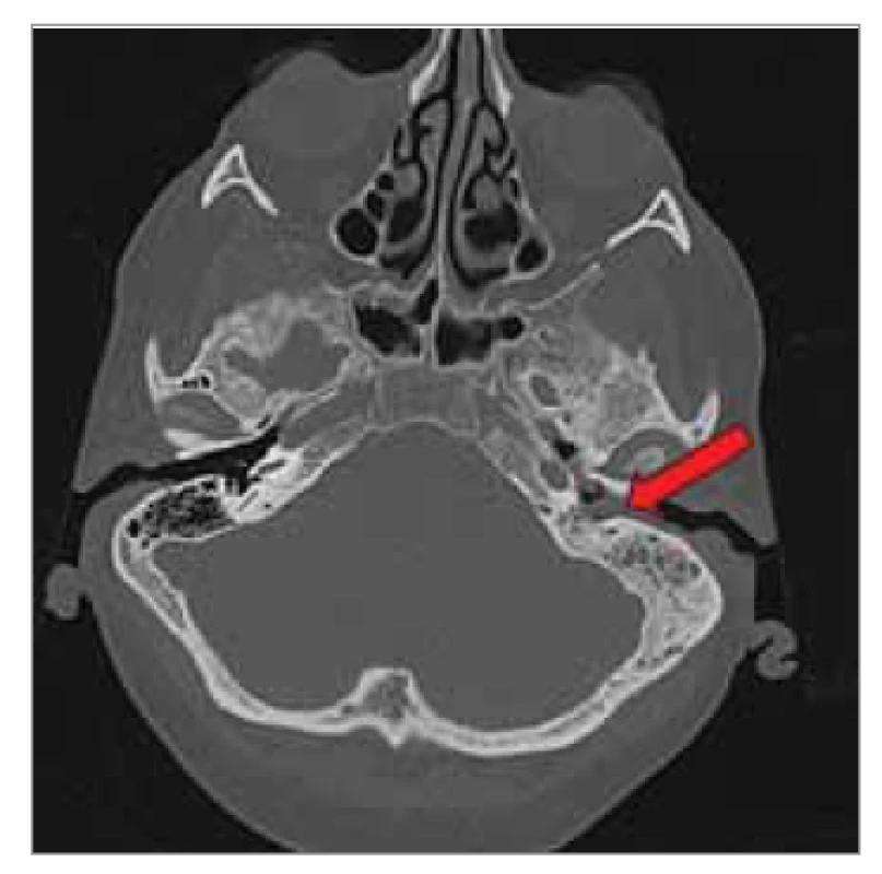 HRCT pyramid, axiální řez: levé
středouší vyplněné tumorózní masou
propagující se směrem do zevního
zvukovodu, bubínek je intaktní, kůstky
jsou destruovány. Tumor se nešíří do
mastoidního výběžku, ale vyplňuje jej
tekutina. Skutum je destruováno.<br>
Fig. 2. HRCT pyramid, axial plane: left
middle ear filled with tumorous mass
propagating towards the external
auditory canal, tympanic membrane is
intact, ossicles are destroyed. The tumor
does not spread to the mastoid
process, which is filled with fluid. The
scutum is destroyed.