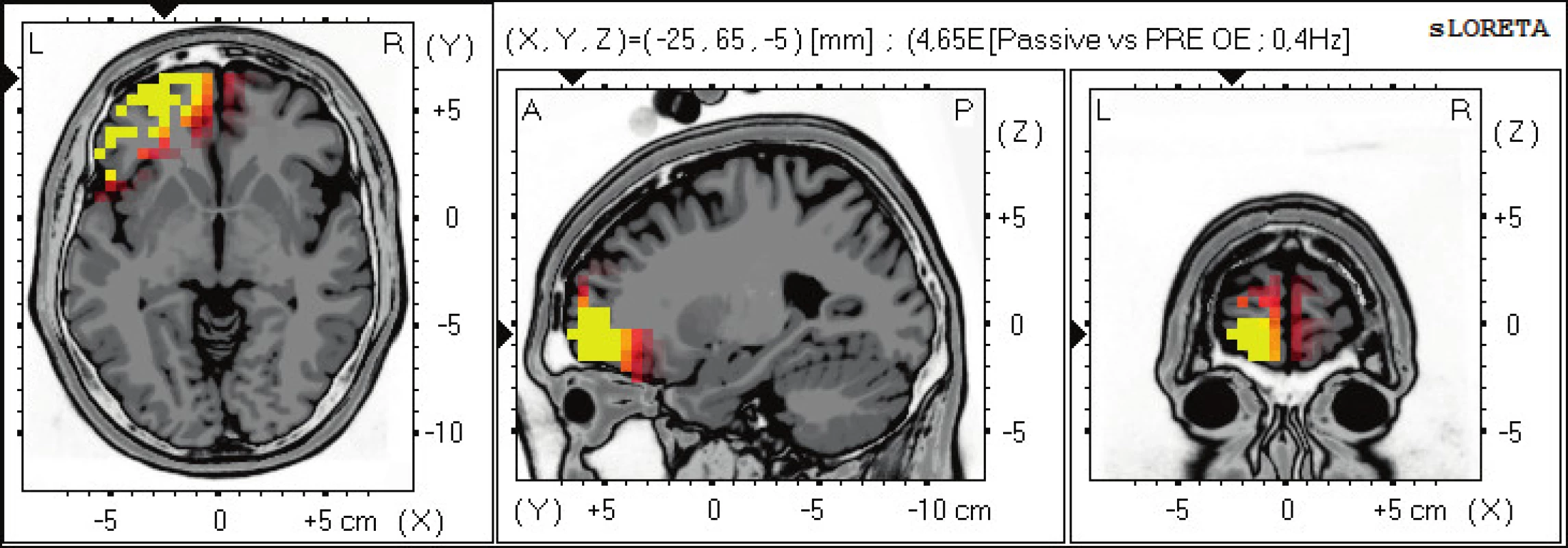 Statistické ne-parametrické mapy sLORETA diference v beta-1, 2 pásmu při porovnání pozorování pasivního sledování pohybu
prováděného terapeutem oproti klidovému záznamu při otevřených očích. Červená a žlutá barva znamená zvýšení zdrojové aktivity nad
levou hemisférou frontálně v BAs 47, 10, 11. Anatomické řezy Talairachova obrazu mají šedou barvu (L – vlevo, R – vpravo).