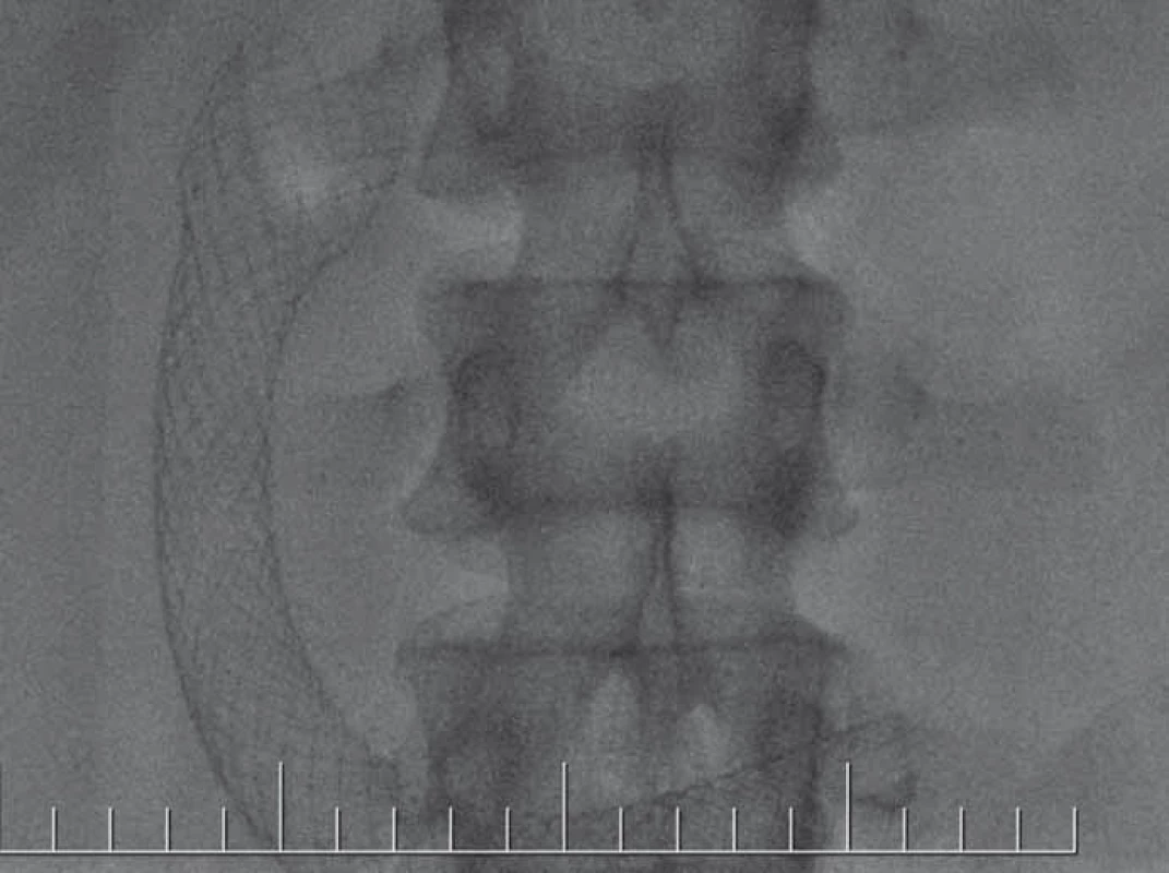 RTG obraz umiestnenia duodenálneho stentu. Zdroj: Archív FN Trnava.<br>
Fig. 3. X-ray image to check the placement of the duodenal stent.
Source: Archive FN Trnava.