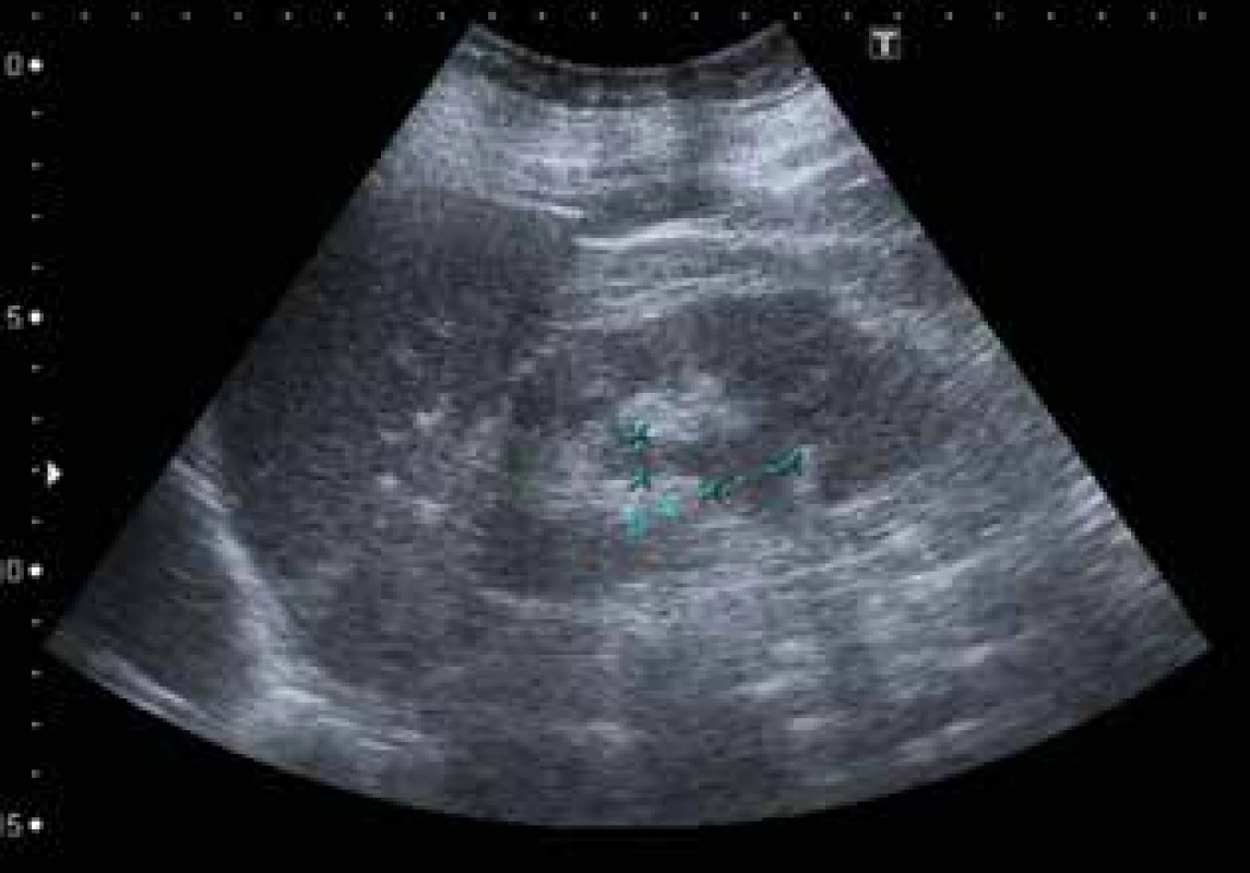 Uroteliální karcinom pánvičky levé ledviny – sonografické vyšetření <br>
Fig. 4: Urothelial carcinoma of the renal pelvis of the left
kidney − ultrasonography