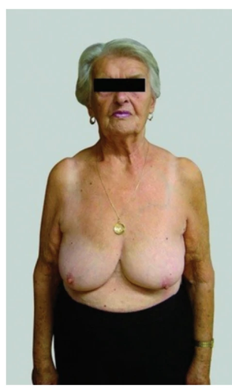 Konzervativní výkon − žena 76 let<br>
Fig. 1: Conservative surgery – a 76-year-old woman