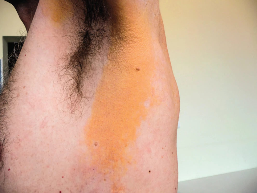 Žluté zbarvení kůže v oblasti ramene na podkladě
xantogranulomu