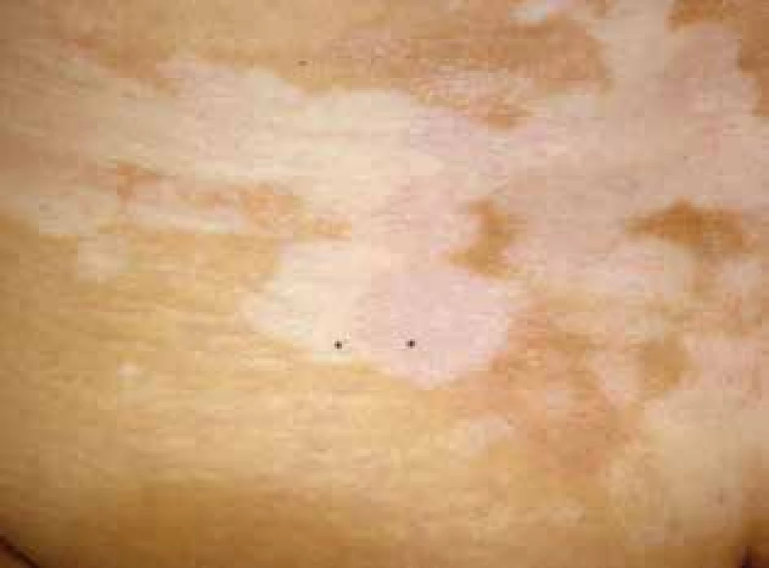 Jasně bílé depigmentace vitiliga, v jejichž okolí a rozsahu jsou bělavě lesklé makuly až ložiska (černé body – levý
v projevu vitiliga, pravý v ložisku lichen sclerosus)
