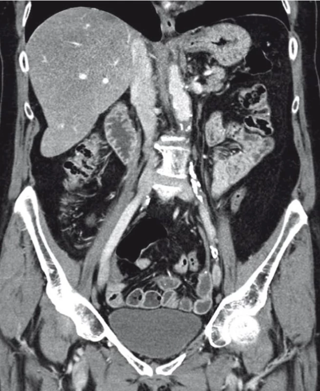 CT vyšetření břicha s intravenózním kontrastem.<br>
Zdroj: MUDr. M. Horák, RTG oddělení Nemocnice Na Homolce, Praha.