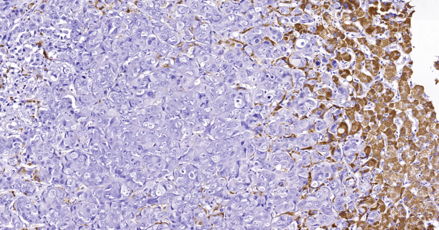 Periferní typ intrahepatálního cholangiocelulárního karcinomu, stejná biopsie jako na obr. 6. Nádorové buňky (vlevo) jsou imunohistochemicky negativní v průkazu HSA, zatímco hepatocyty (vpravo) se pozitivně barví hnědě. Histologický řez z punkční biopsie, imunohistochemie HSA, 20×.