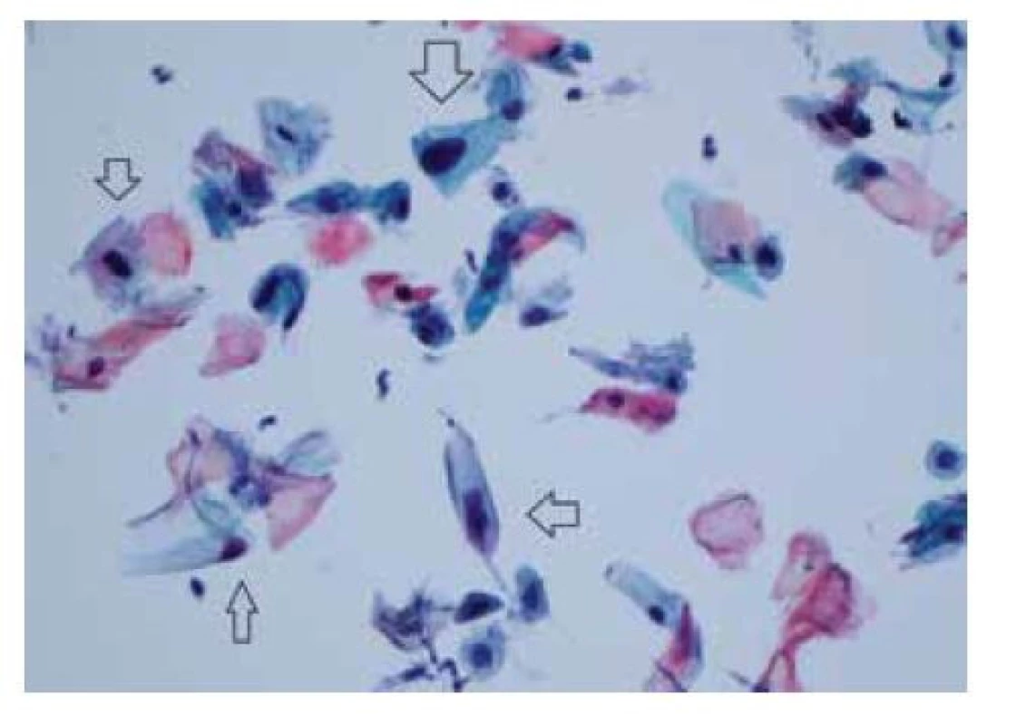 LSIL (low-grade skvamózní intraepiteliální léze) –
anální cytologické nátěry LBC (liquid-based cytology) diagnostikované
jako LSIL obsahují velké dysplastické buňky
skvamózního původu vykazující znaky odpovídající infekci
HPV (šipky)<br>
(barvení podle Papanicolaou, zvětšení 400x)
