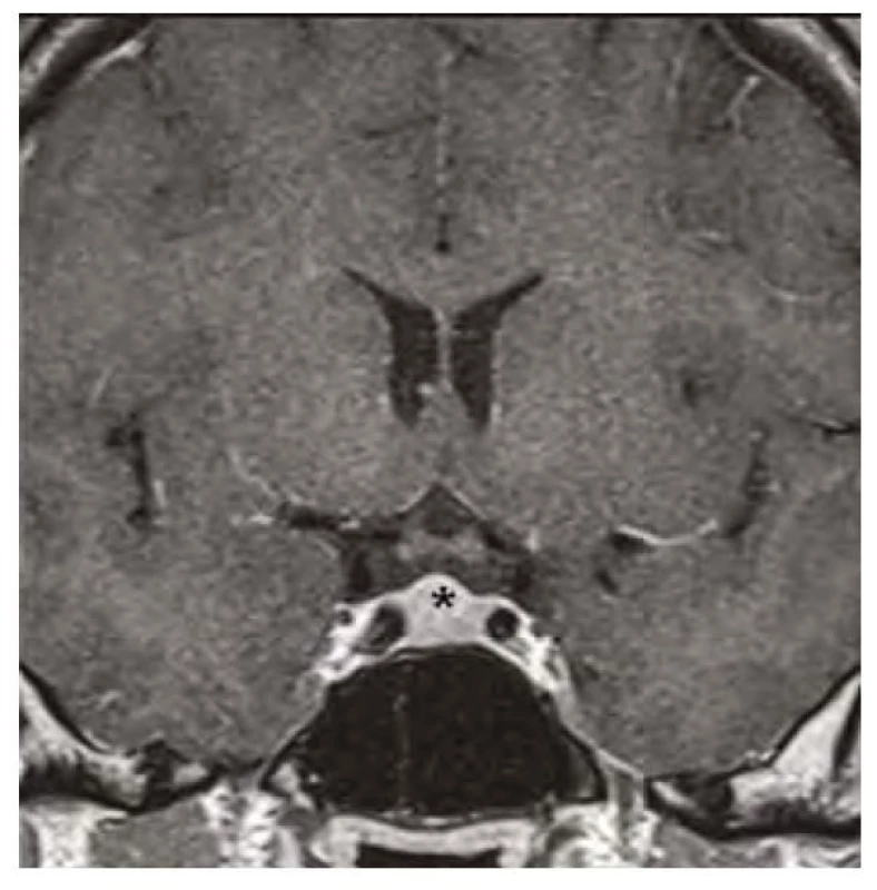 Kontrolní magnetická rezonance mozku ve frontálním řezu v postkontrastním
T1-váženém obraze, hvězdička označuje zmenšenou hypofýzu
po 12 měsících substituční hormonální léčby