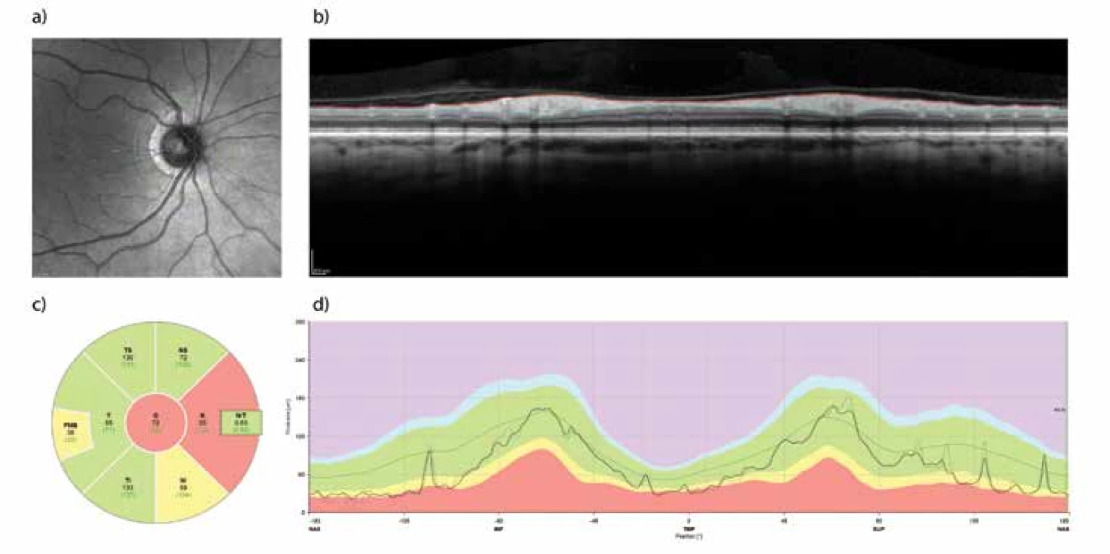 Retinal Nerve Fibre Layer (RNFL) measured with the aid of optical coherence tomography (OCT). Example of examination
of the retina of the right eye before surgical decompression of the chiasm in a 65-year-old woman. Measurement of the
“peripapillary RNFL” takes place along the green circle (a). The profile of the retinal layers in the indicated trajectory is on panel
(b), where the bordering of the internal limiting membrane and the interface between the axonal fibres and the bodies of the
retinal ganglion cells are also indicated. The difference between both profiles forms the thickness of the peripapillary RNFL,
and is illustrated on panel (d) as the thicker line running through the green band indicating the normal values for the given age
group. The average and normative values of RNFL thickness in the nasal and temporal quadrant and their superior and inferior
parts together with the global value are shown in panel (c). The nasal quadrant shows a reduced thickness of the RNFL as a
consequence of compression of the crossed fibres of the optic nerve