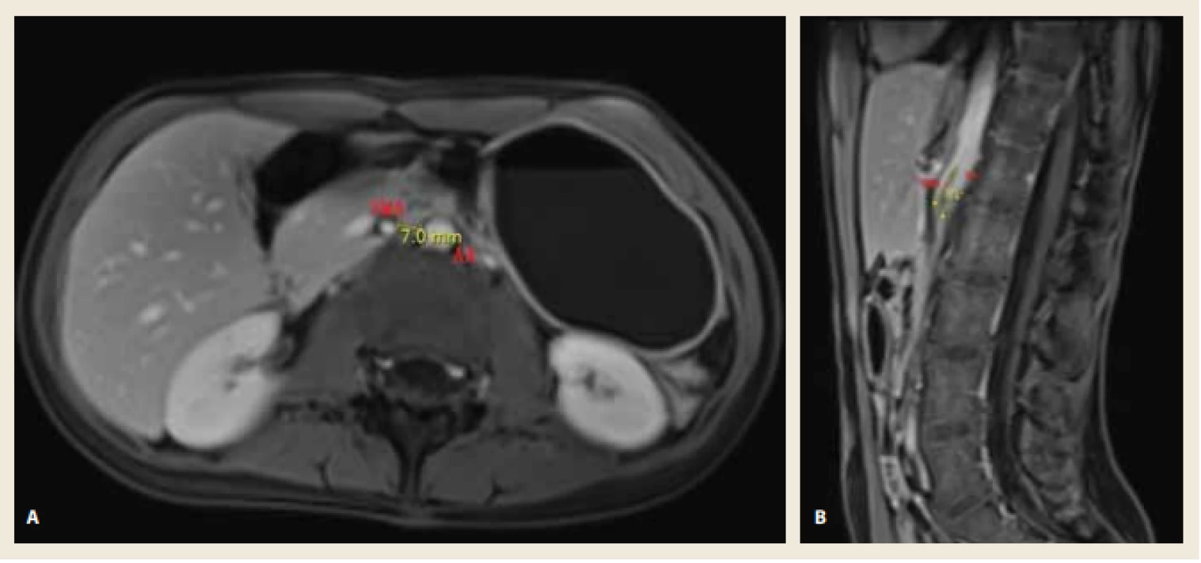 A. MR enterografie (PK T1 VIBE FS, transverzální rovina) s patrným snížením aortomezenterické vzdálenosti na 7 mm.<br>
Obr. 1B. MR enterografie (PK T1 VIBE FS, sagitální rovina) s patrným snížením aortomezenterického úhlu na 14°. <br>
Fig.1A. MR Enterography (PK T1 VIBE FS, axial view) shows the reduction of aortomesenteric distance to 7 mm.
Fig. 1B. MR Enterography (PK T1 VIBE FS, sagittal view) shows the reduction of aortomesenteric angle to 14. 