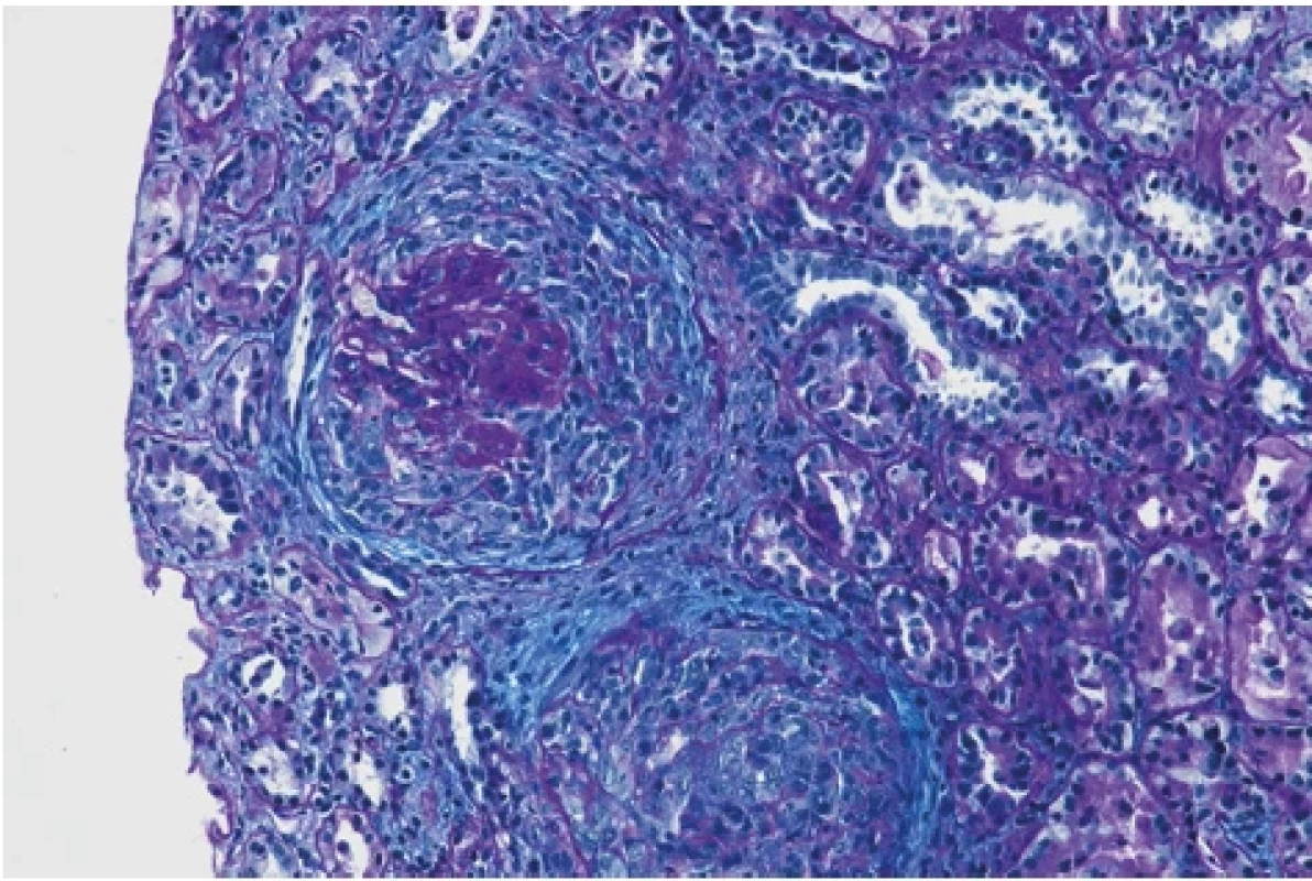 Okludující srpek a pod ním zaniklý glomerulus (barvení PA, zvětšení 200×), archiv autorů