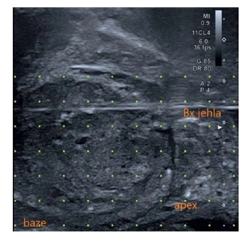 Transrektální ultrasonografie prostaty – sagitální
pohled [61]<br>
Fig. 3. Transrectal ultrasonography of the prostate – sagittal
view [61]