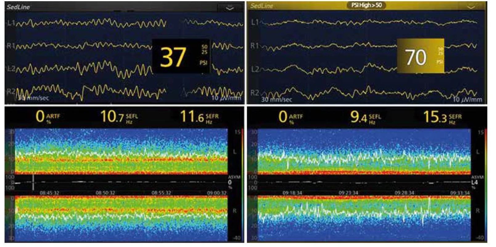 EEG křivky a spektrogramy při doplňované anestezii kombinací sevofluran + sufentanil při ventilaci směsí kyslík + vzduch (vlevo), nebo s 70%
oxidem dusným (vpravo) u 71letého pacienta podstupujícího plastiku a. femoralis