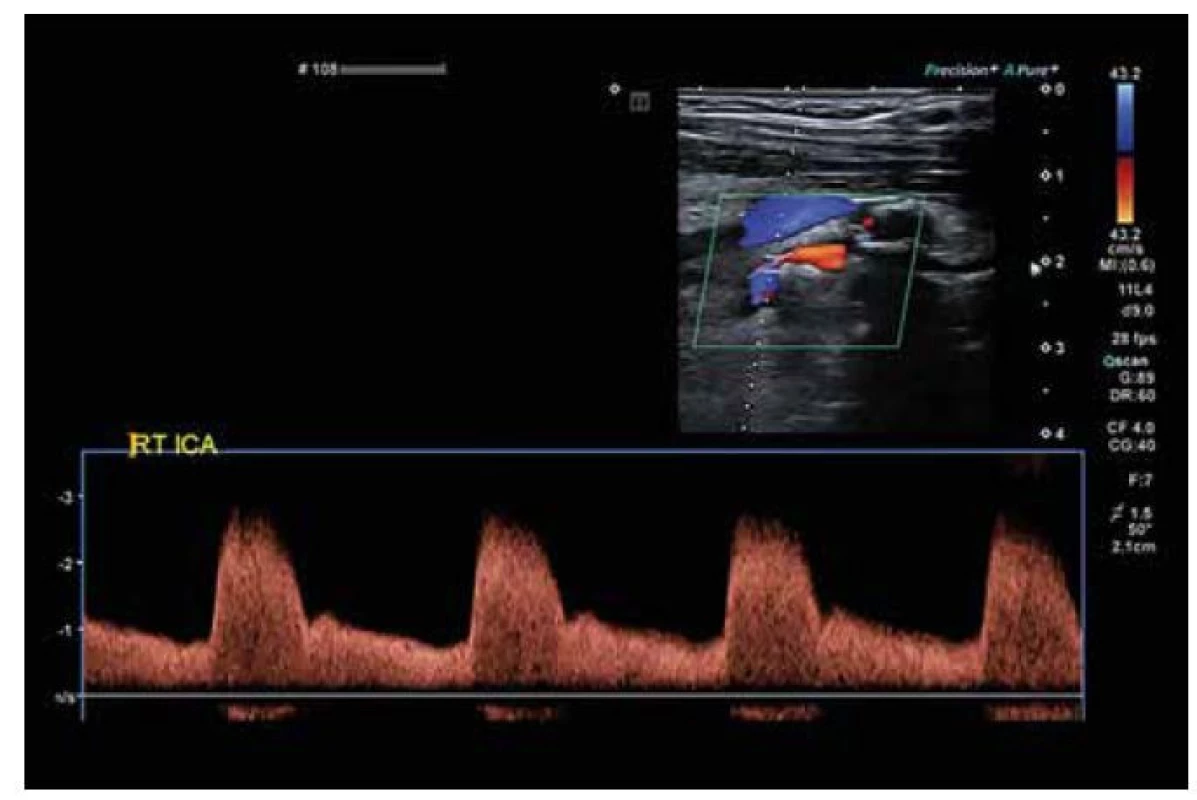 Ultrasonografické zobrazení významné stenózy vnitřní karotické tepny (ICA).