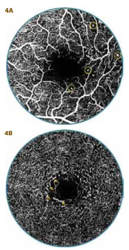 OCT-A  vyšetření 29letého
diabetika (26 let trvání diabetu) s mírnou
neproliferativní diabetickou retinopatií
(NPDR)<br>
A. Foveální avaskulární zóna (FAZ) je značně rozšířená a nepravidelná, povrchový
vaskulární komplex s  mnohočetnými
zónami neperfuze, mikroaneurysmaty
(v kroužku) a výrazným přesahem cévně kapilárních svazků do FAZ<br>
B. Plocha FAZ - 0,58 mm², hluboký vaskulární komplex s  četnými zónami
neperfuze a  prořídnutí kapilární sítě
s ložisky její dilatace (šipky)