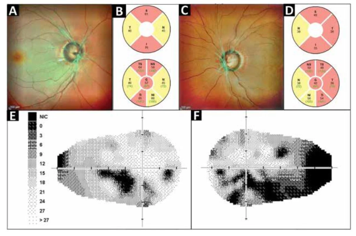 Klinické nálezy u probanda z rodiny č.1 v době první návštěvy na našem pracovišti. SD-OCT
MultiColor fotografie očního pozadí oka pravého (A) a levého (C) ukazující glaukomovou exkavaci na obou
očích, měření peripapilární tloušťky RNFL pravého oka (B) a levého oka (D) dokumentující významné snížení
na hodnoty pod 5 (žluté sektory) a 1 (červené sektory) percentilem normativní databáze, statická automatická
perimetrie (glaukomový program) pravého oka s absolutními skotomy v dolní Bjerrumově oblasti (E) a levého
oka (F) kde jsou patrné ne zcela typické skotomy pouze částečně odpovídající Bjerrumově oblasti avšak
vysoce korelující s hodnotami RNFL