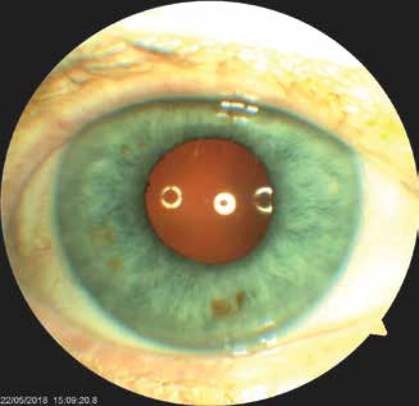 Oko jednoho z pacientů po implantaci Schariothovy
makulární čočky, centrální ploška dobře centrována