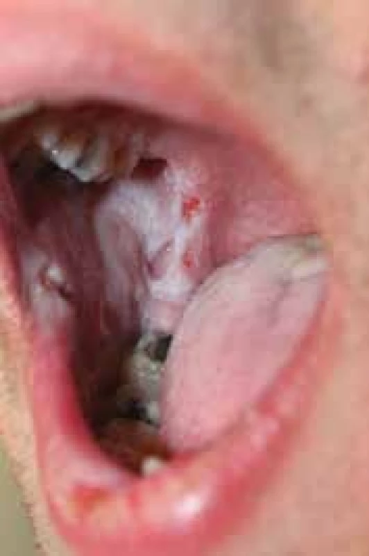 Osmnáctiletý pacient s  pemphigus vulgaris při přijetí
v listopadu 2015 projevy v dutině ústní