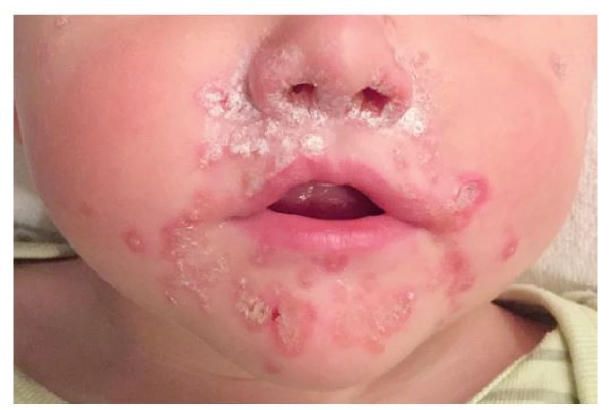 Dvouletý chlapec s impetigem – při stafylokokové rýmě se
rozšířilo z vchodu nosního