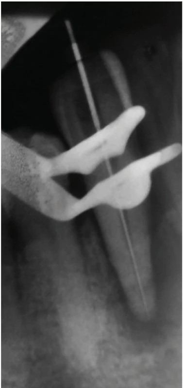 Měřicí snímek<br>
Fig. 2
Working length radiograph