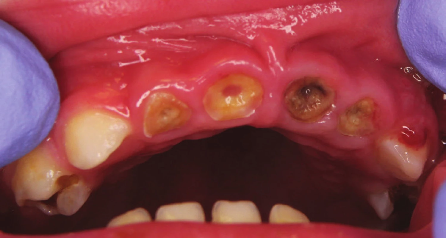 The carious primary dentition of the 26-months-old child with inflammation of the alveolar bone ridge of upper jaw in frontal area