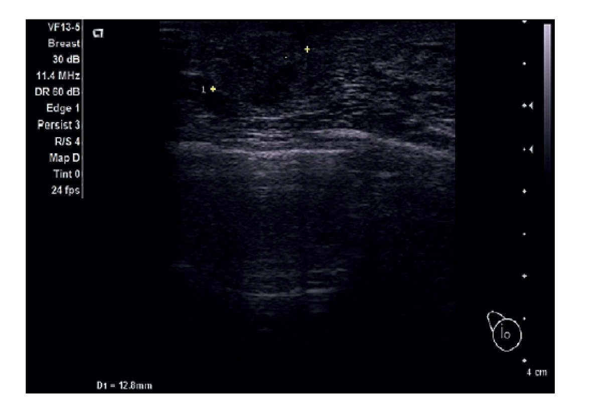 UZ prsu, rezistence v jizvě.<br>
Fig. 6: Ultrasound of the breast, resistance in the scar.