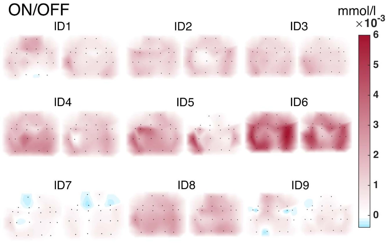 NIRS Brain Mapping visualization. Cubic interpolation patterns of HbO activity in the cortical regions of the brain in the motor task (finger tapping) ON vs. OFF DBS-STN.