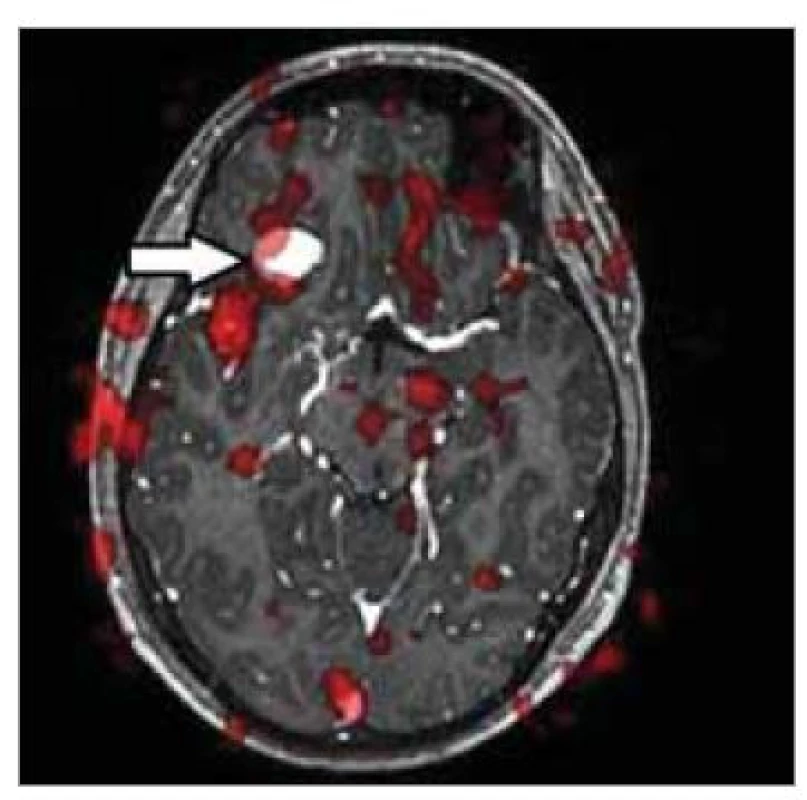 MR – tumor s aktivitou v řečových
zónách.<br>
Fig. 1. MRI – tumor active in speech
zones.