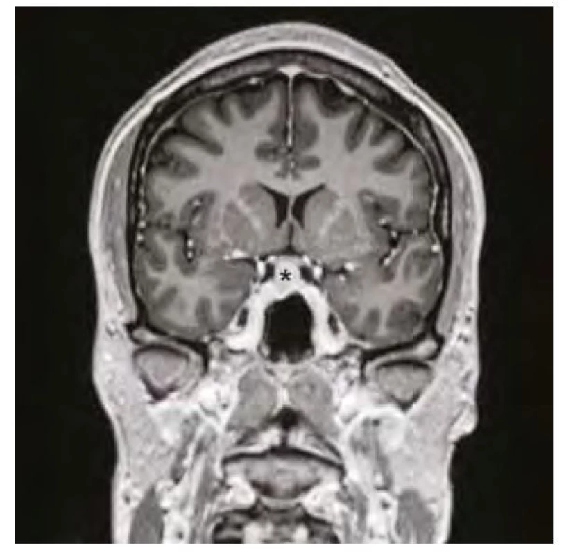 Magnetická rezonance mozku ve frontálním řezu v postkontrastním
T1-váženém obraze, hvězdička označuje zvětšenou hypofýzu před
zahájením substituční léčby hypotyreózy