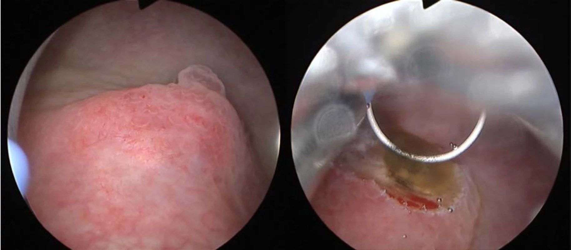Cystoskopie a TUR biopsie: tumorózní útvar na zadní stěně močového měchýře<br>
Fig. 2. Cystoscopy and TUR biopsy: tumorous formation on the bladder back wall