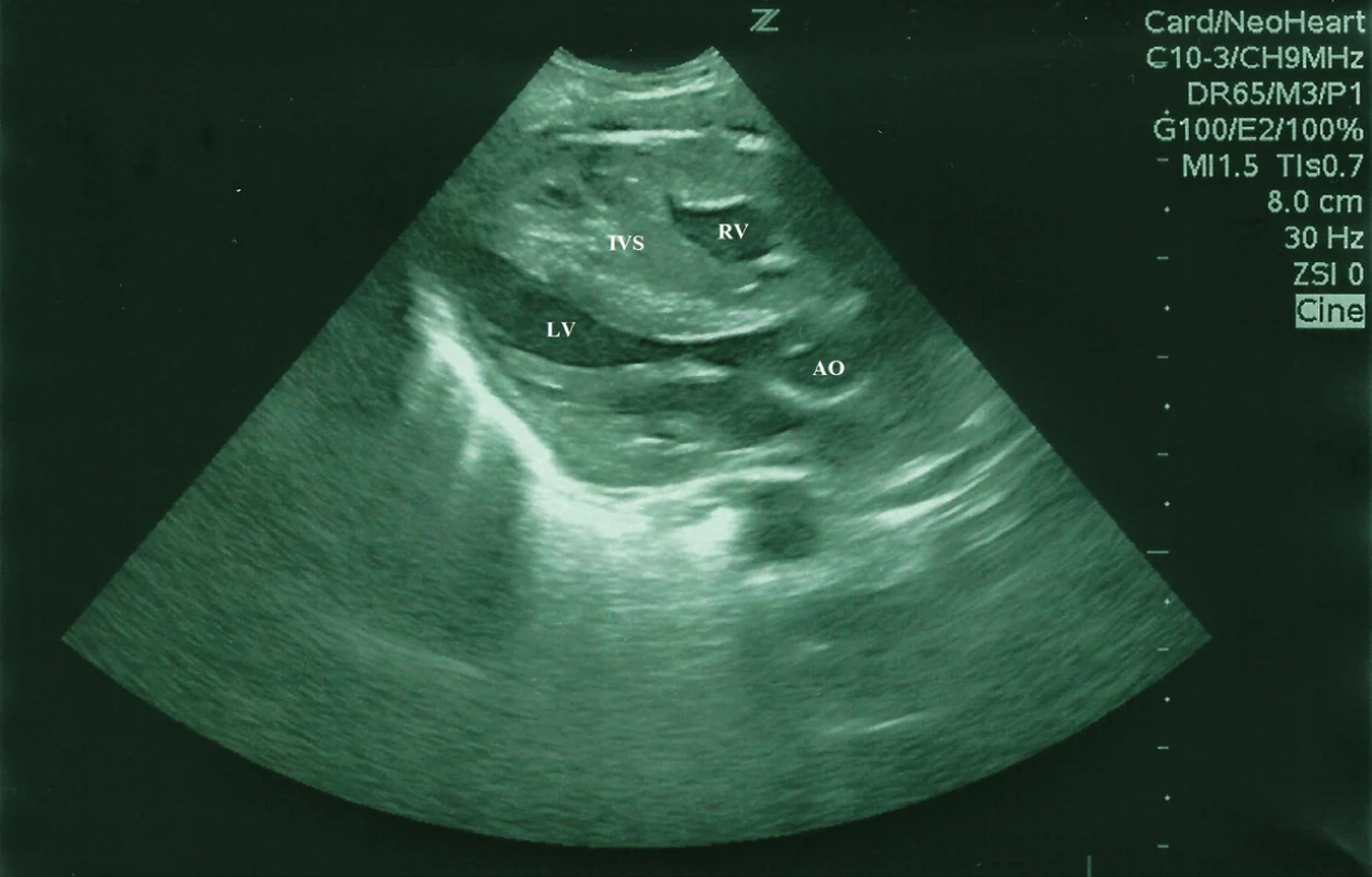 Bidimenzionálny echokadiogram, parasternálne dlhá os, obraz hypertrofickej KMP u novorodenca, asymetrická hypertrofia interventrikulárneho septa (IVS) a ľavej komory (LV), konvexita IVS prominuje do dutiny LV. <br>Fig. 1. Bidimensional echocardiogram showing long axis parasternal views of the left ventricle of a newborn, hypertrophic cardiomyopathy, asymmetrical hypertrophy of the septum and left ventricular hypertophy. There is convexity toward the left ventricular cavity.