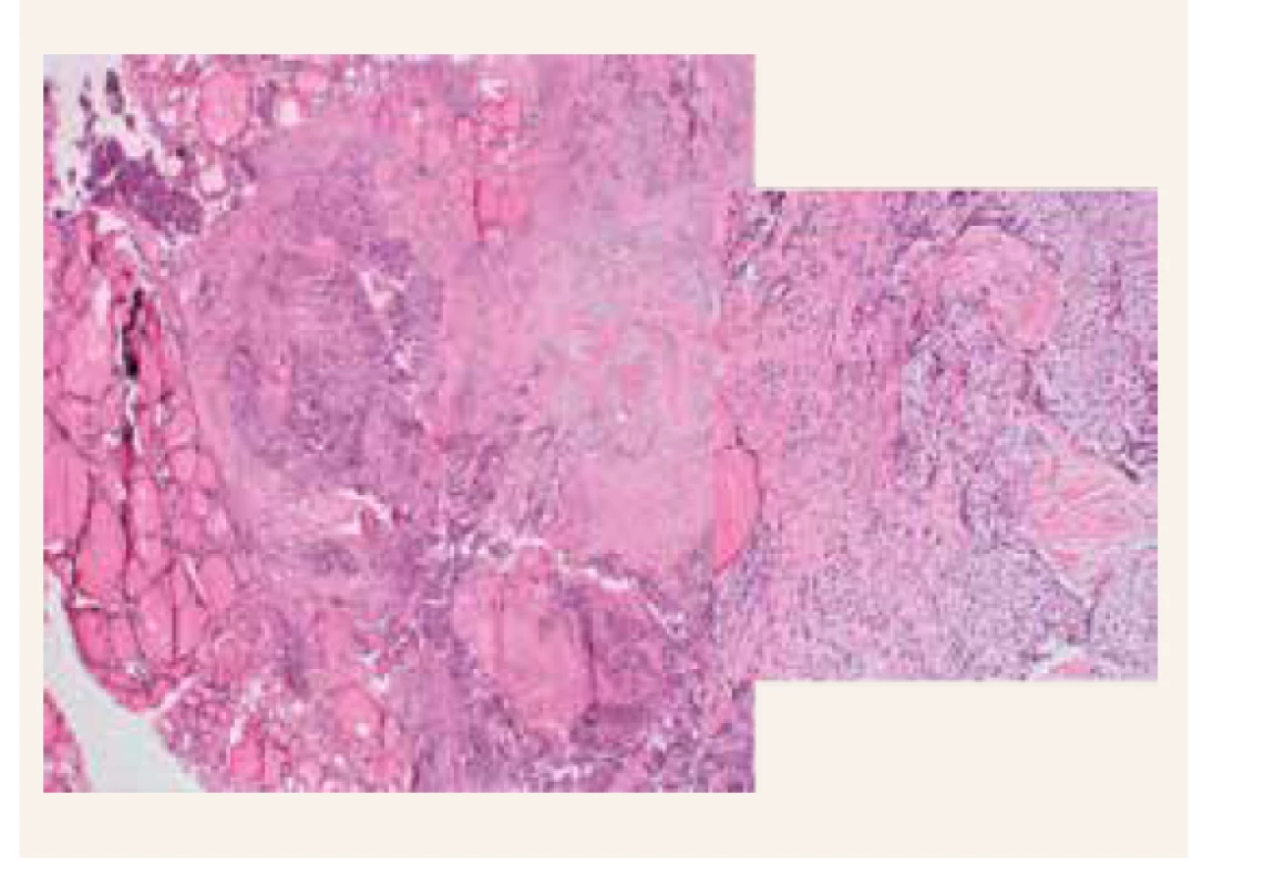 Karcinóm prištíneho telieska v ľavom laloku
štítnej žlazy