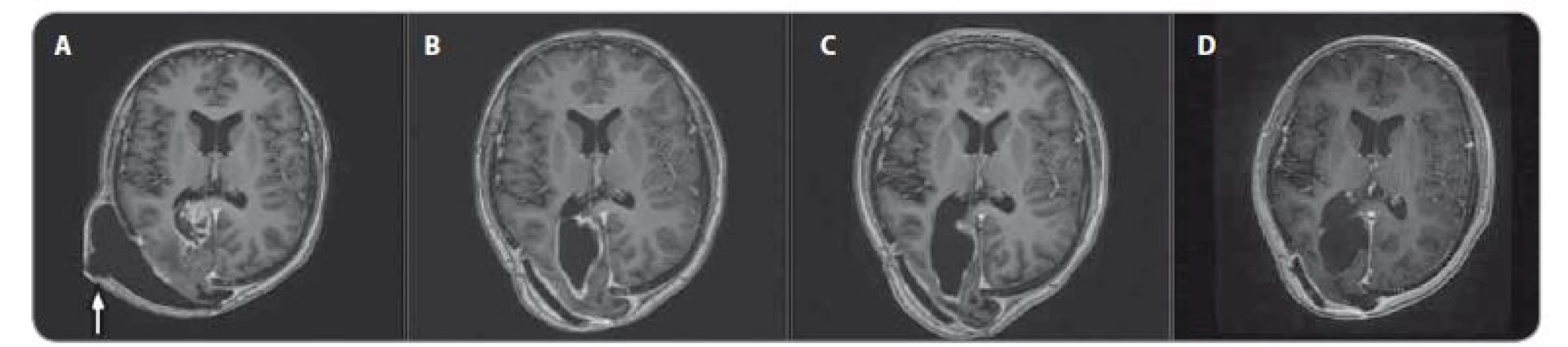 MRI, T1 vážené obrazy s kontrastem – pokračující léčebná odpověď. A) před terapií, B) po 3 měsících, C) po 6 měsících, D) po 15
měsících nivolumabu, bílá šipka označuje pooperační pseudomeningokélu.