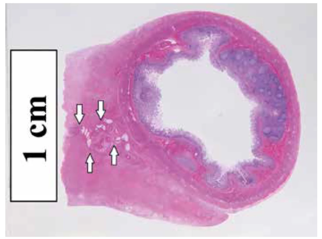 Histotopogram fibrotického zhrubnutia terminálneho mezentéria
s jeho pôvodnými štruktúrami (šípky). Farbenie hematoxylín-eozín.
