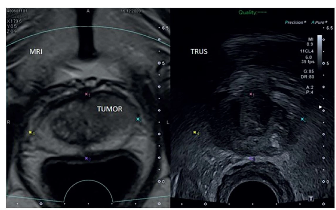 MRI/TRUS fúzní biopsie s ložiskem PI-RADS 5 v levém laloku ventrálně [61]<br>
Fig. 2: MRI/TRUS fusion biopsy with a PI-RADS 5 lesion in the anterior part of the left lobe [61]