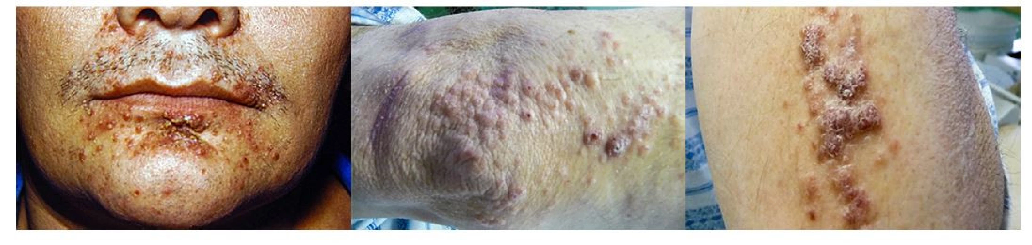 LCH infiltruje často intertriginózní oblasti, ale může se objevit i na obličeji a na paži. Makroskopicky může připomínat folikulitidu a jedině histologické
vyšetření excize kůže může správně stanovit diagnózu. Proto u špatně se hojících či nehojících se kožních morf je na místě vždy histologická verifikace
kožního onemocnění