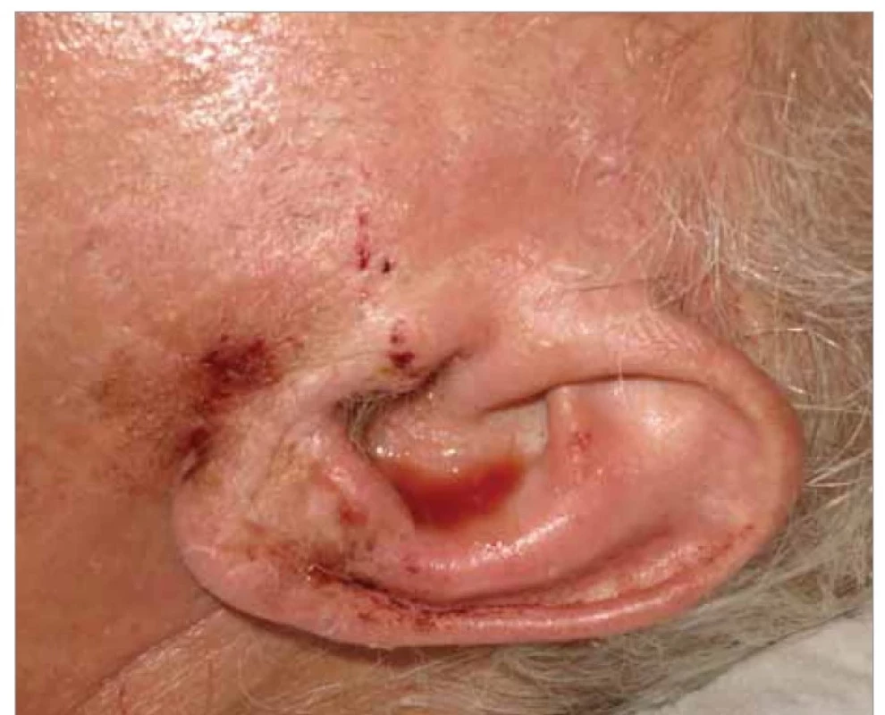 Pohled na tekoucí levé ucho.<br>
Fig. 1. View of drainage from the left ear.