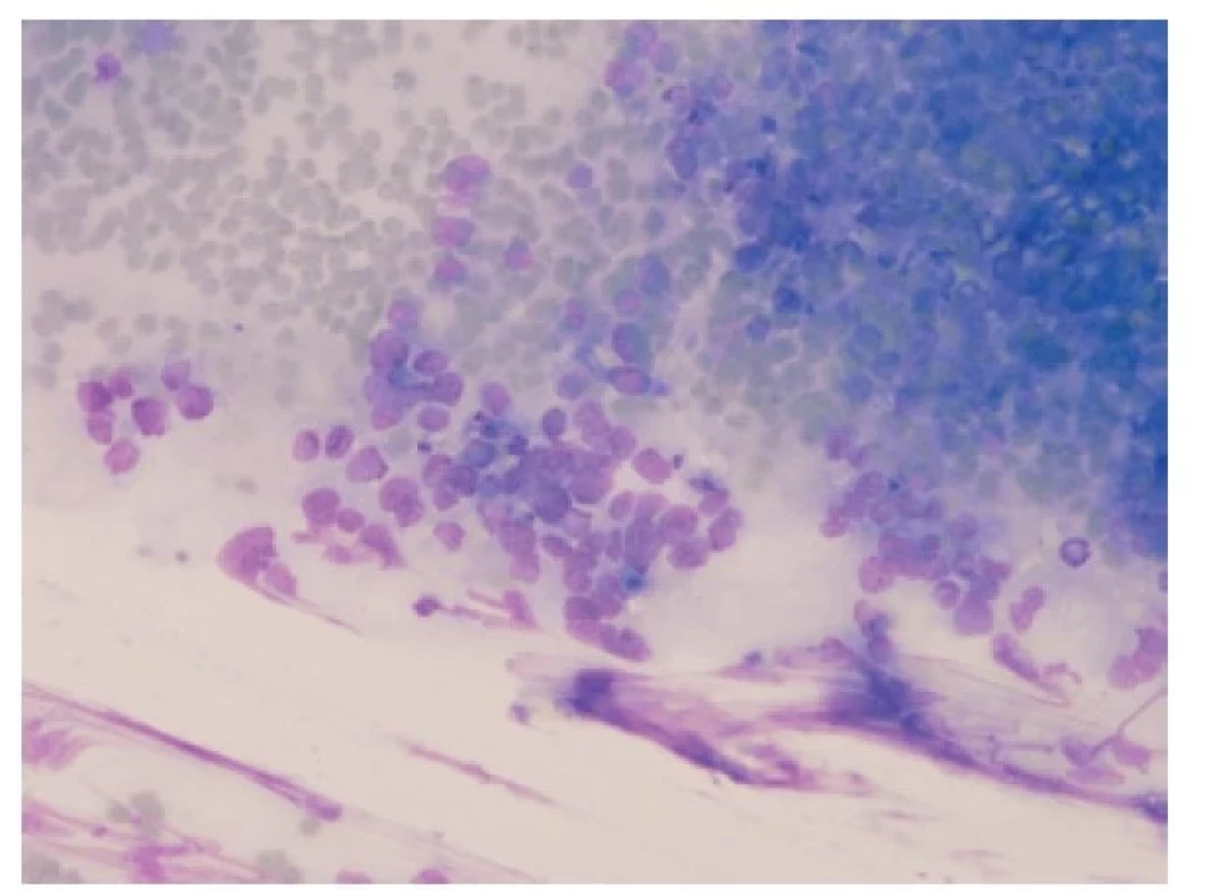Cytologický vzhled malobuněčného plicního karcinomu. „Puzzling“
jader, granulovaný chromatin, nepřítomnost jadérek, mitotická aktivita.
Giemsa, 200x.
