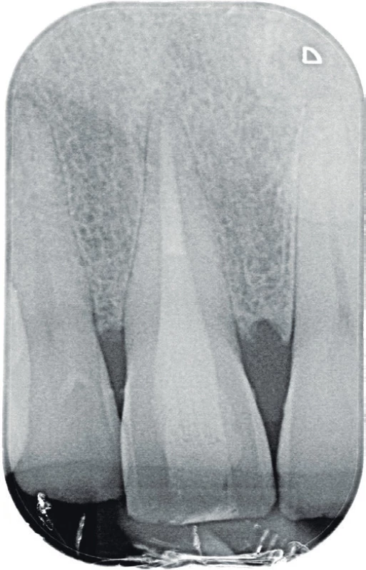 Diagnostický intraorální
rentgenový snímek
zubu 11 v apikálním zastavení
zhotovený dva roky po
reendodontickém ošetření
zubu 11. Je jasně viditelná
periodontální štěrbina bez
známek rozšíření