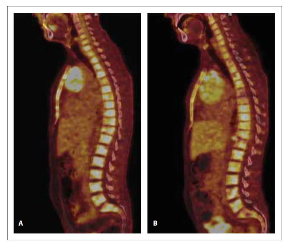 PET/CT a CT skeletu v době diagnózy (A) a po 1. konsolidaci (B). Na
snímku A (PET/CT) je ve všech úsecích páteře, v obou klíčcích a lopatkách,
ve sternu, v pánvi, v proximálních partiích obou humerů a femurů přítomna
zvýšená akumulace 18F-FDG (SUVmax 8,9). Na snímku B (PET/CT) a je prokázána
zvýšená akumulace 18F-FDG (SUVmax 7,6) nehomogenně difuzně v celém
zobrazeném skeletu.