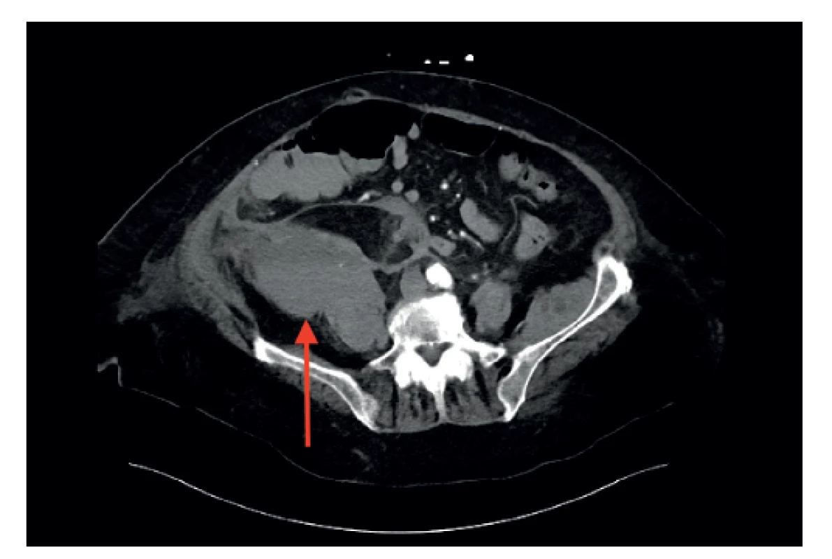 Pacientka 2, CT vyšetření ve venózní fázi, hematom
pravého retroperitonea značen šipkou<br>
Fig. 2: Patient 2, venous phase CT, large hematoma in the
right retroperitoneum (arrow)