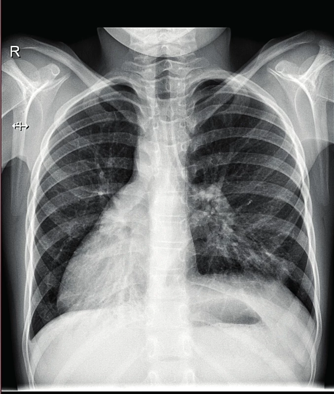 Skiagram hrudníku, 9letá pacientka s PCD a dextrokardií – zvýrazněná plicní kresba, chronické atelektaticko-infiltrativní změny mediobazálně bilaterálně.<br>
Fig. 5. X-ray of the chest, 9-year-old patient with dextrocardia – enhanced density of the pulmonary tissue, chronic atelectatic and infiltrative changes in medio-basal
region bilaterally