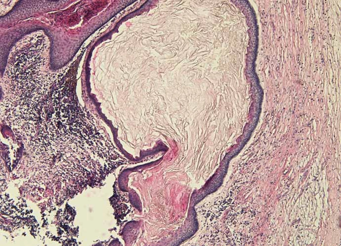 Histologický obraz odontogénnej epidermoidnej cysty.
