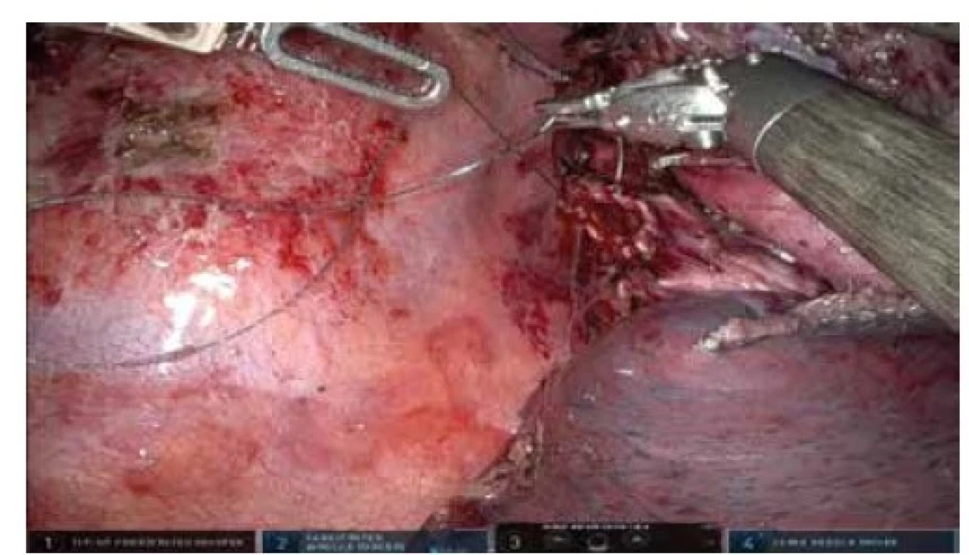 Robotická segmentektomie S6 vpravo, robotická
sutura bronchiálního defektu<br>
Fig. 4: Robotic segmentectomy S6 right, robotic suture of
a bronchial defect
