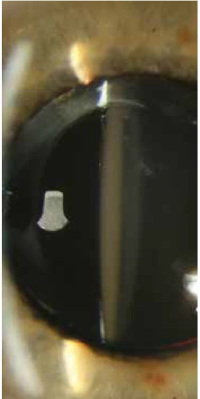 Přední segment – zkalená NOČ AcryNovaTMPC
610Y před explantací