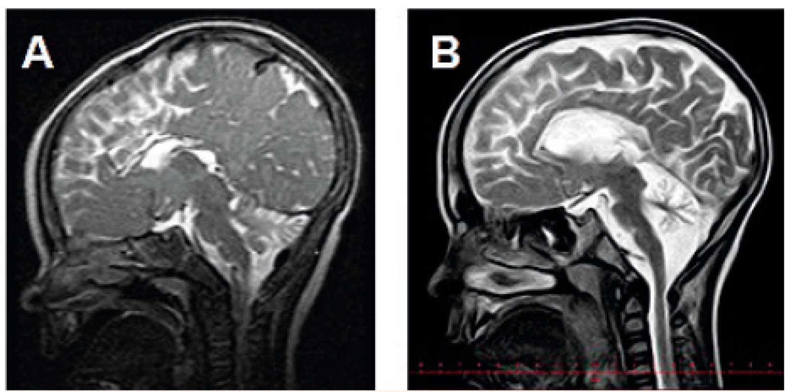 MR mozku (T2W) s progresivní atrofizací mozečku
u chlapce s PMM2-CDG: tentýž pacient ve věku
A – 10 měsíců, B – 6,5 roku.<br>
Fig. 3. Brain MRI (T2W) showing progressive cerebellar atrophy
in a boy with PMM2-CDG: the same patient at the
age of A – 10 months, B – 6.5 years.