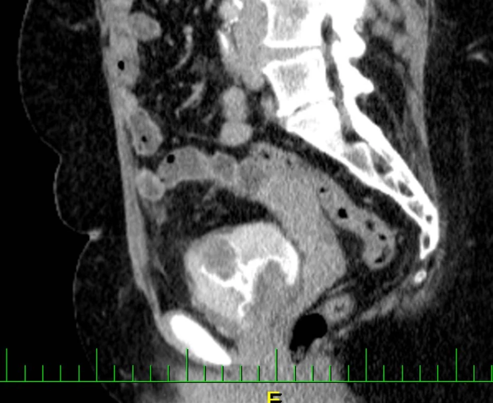 CT vyšetření zachycující intraluminální expanzi v augmentovaném močovém měchýři<br>
Fig. 3. CT examination capturing intraluminal expansion in the augmented bladder