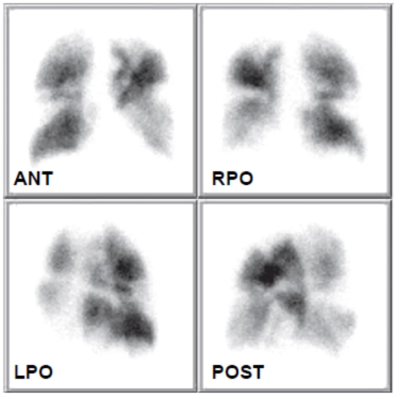 Obraz distribuce plicní perfuze 22. 9. 2008 prokazuje recidivu
embolie do plicnice – jsou patrné vícečetné segmentové defekty
v obou plicních křídlech.