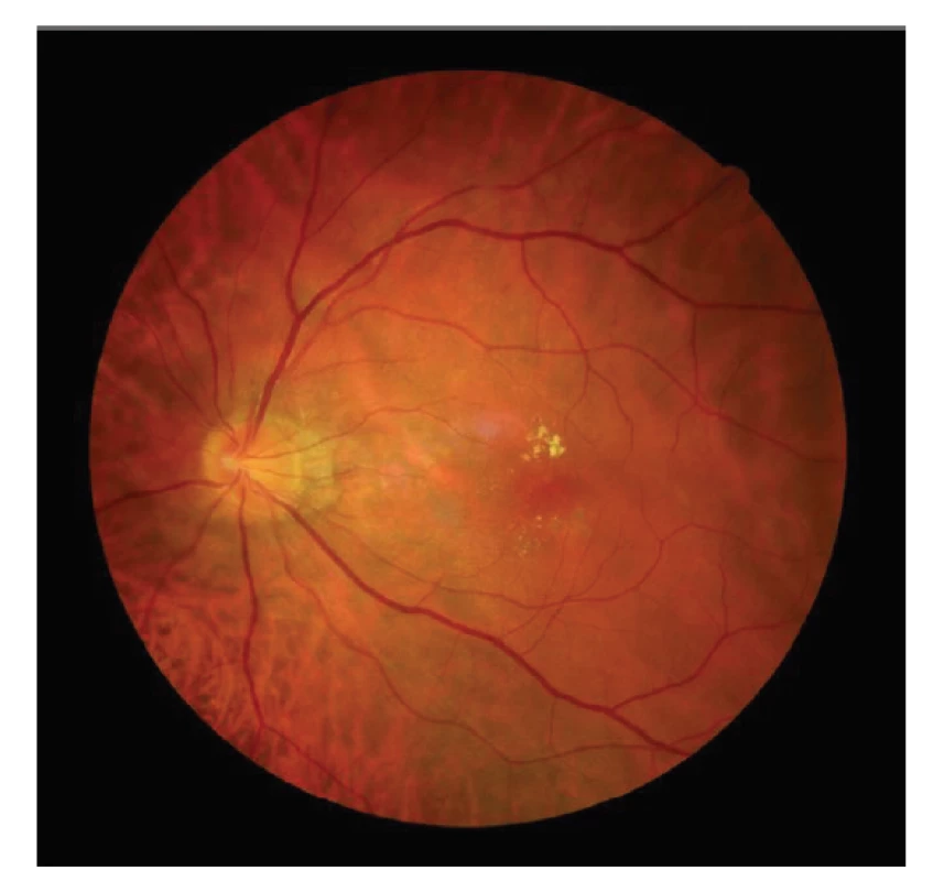 Snímek očního pozadí levého oka pacienta
s choroidální makrocévou