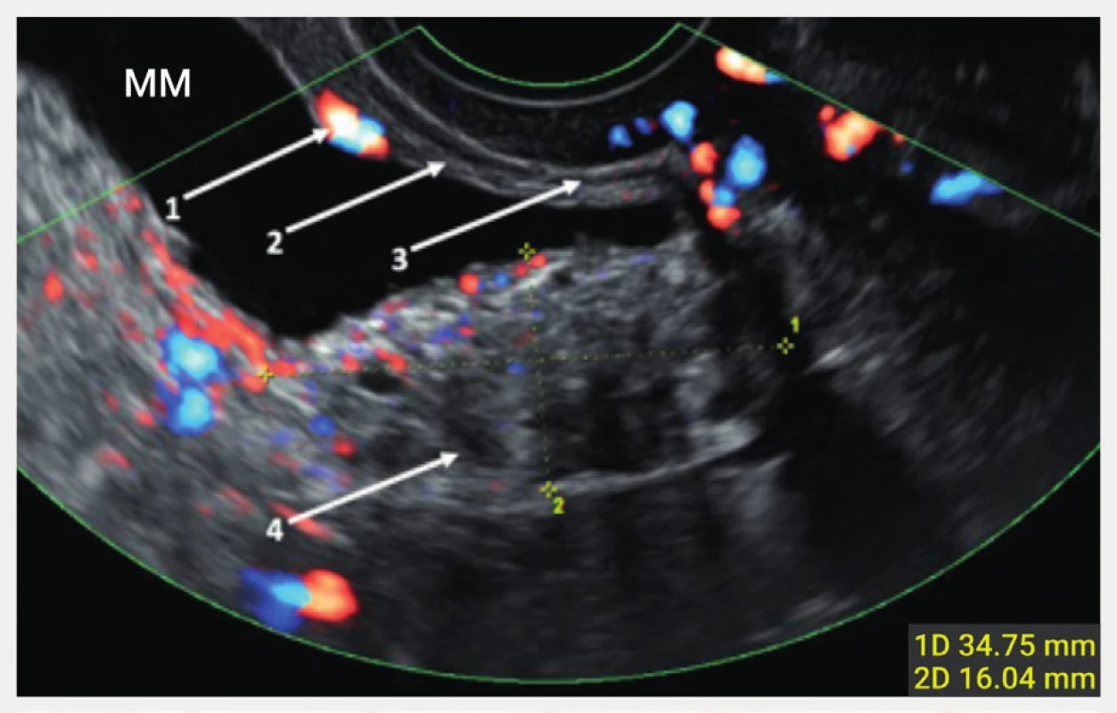 Vrstvy močového měchýře při zobrazení ultrazvukem<br>
Ultrazvukový nález močového měchýře s hlubokou endometriózou
(ohraničena kalipery) v oblasti baze měchýře.
1 – ústí močovodu, 2 – submukóza, 3 – svalová vrstva, 4 – hluboká
infiltrující léze zasahující až do submukózy
MM – močový měchýř