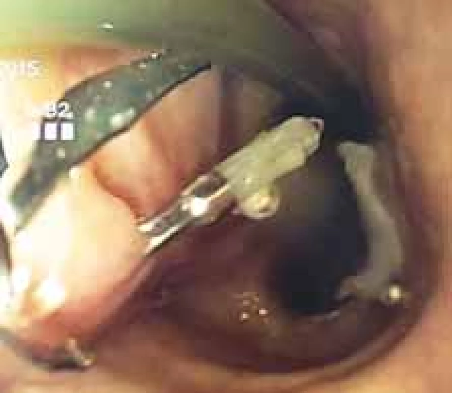 Through the scope clipping in
minor tracheoesophageal fistula.
Obr. 2. Klipování malé tracheoezofageální píštěle hemoklipy.